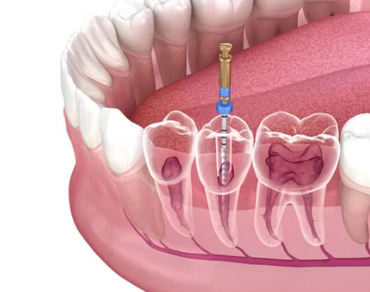 Painless root canal round thumbnail